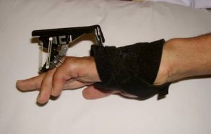 Digit Widget - to aid in the treatment of PIP flexion contractures