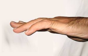 Digit Widget - to aid in the treatment of PIP flexion contractures
