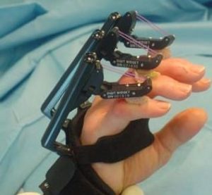 Digit Widget - to aid in the treatment of PIP flexion contractures